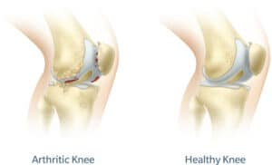 Arthritic and Healthy Knee