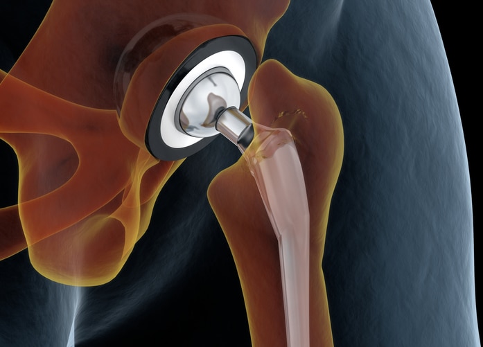 Medically accurate illustration of the hip replacement. 3d illustration. Medically accurate illustration of the hip replacement. 3d illustration.