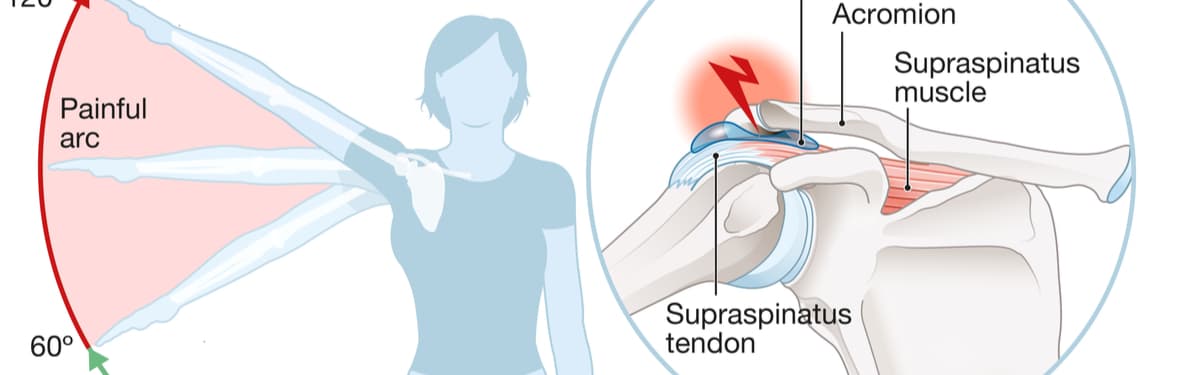 shoulder impingement syndrome